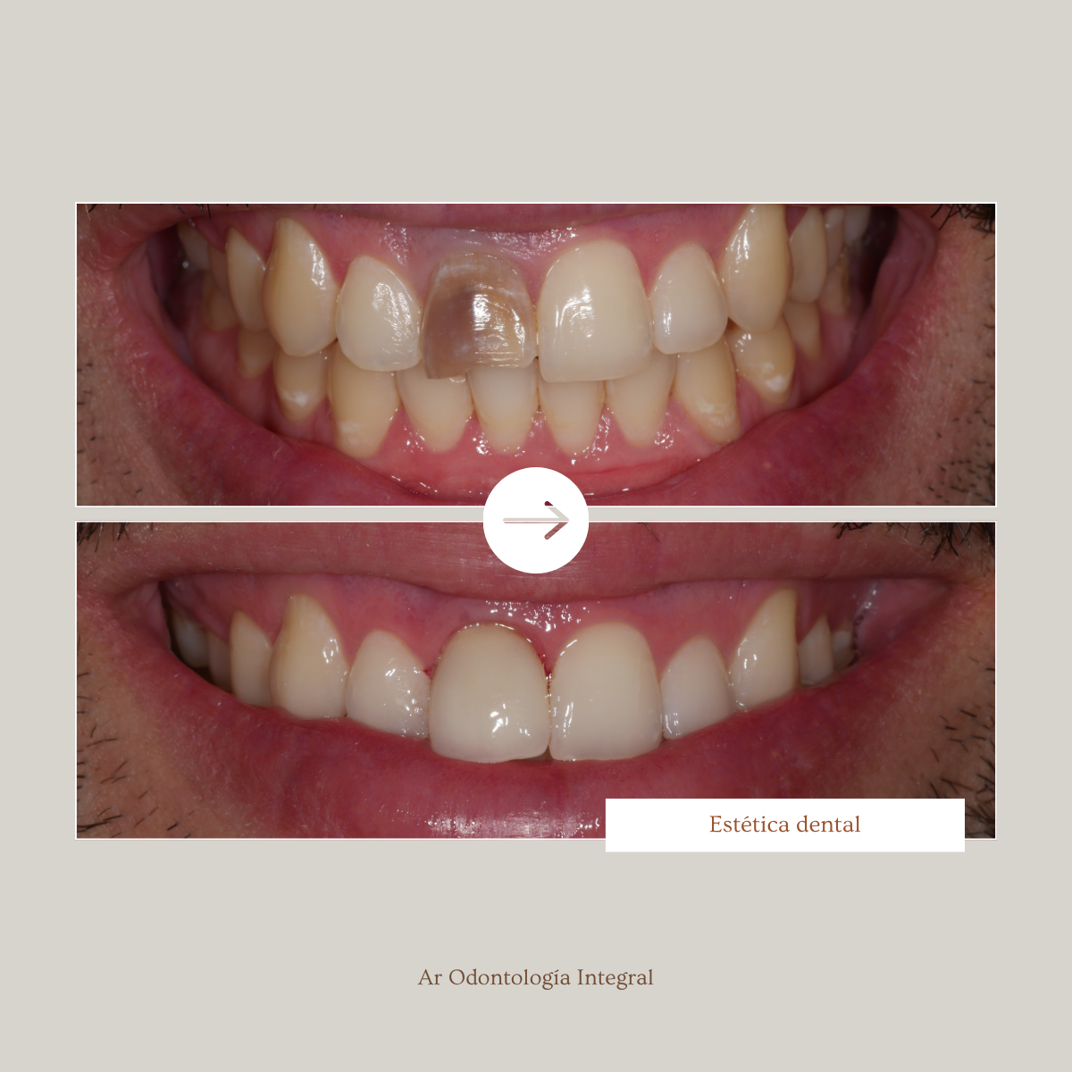 Antes y después — Estética Dental